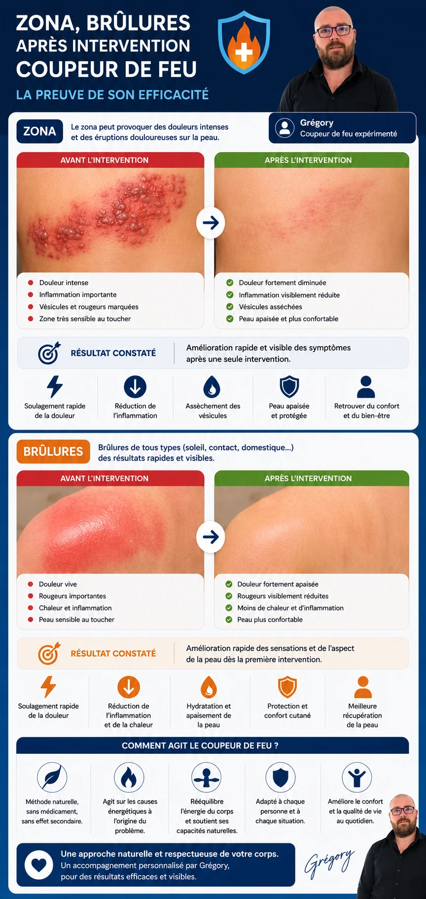 Zona et brûlures avant et après l'intervention du coupeur de feu : douleur fortement diminuée, inflammation visiblement réduite, peau apaisée. Le coupeur de feu ne remplace pas un suivi médical.